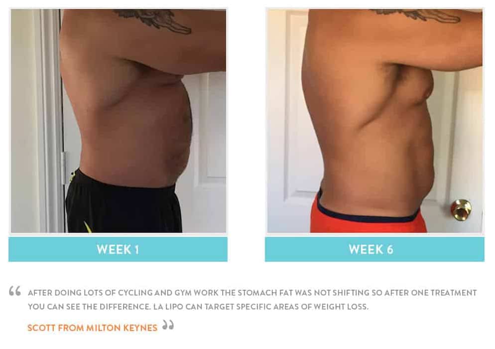 Before & After Stomach Fat Greater London (Hammersmith and Fulham)