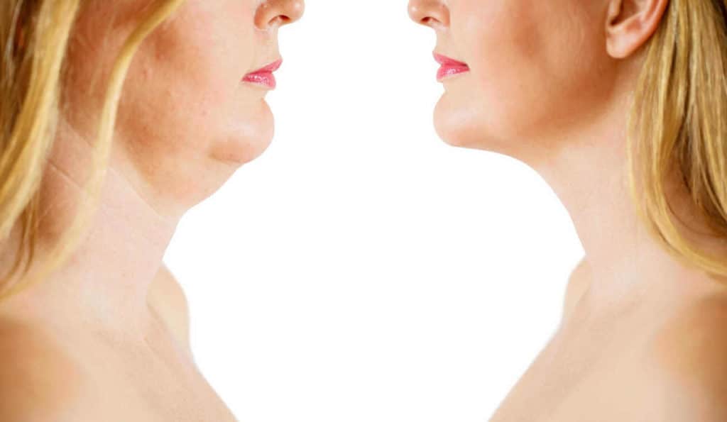 Double Chin treatment Greater London (Hammersmith and Fulham) before and after results
