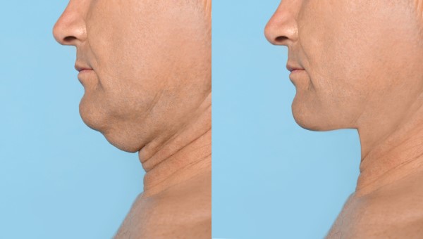 Which Non-Surgical Treatments Work Best for Jowls and Loose Skin Greater London (Hammersmith and Fulham)?