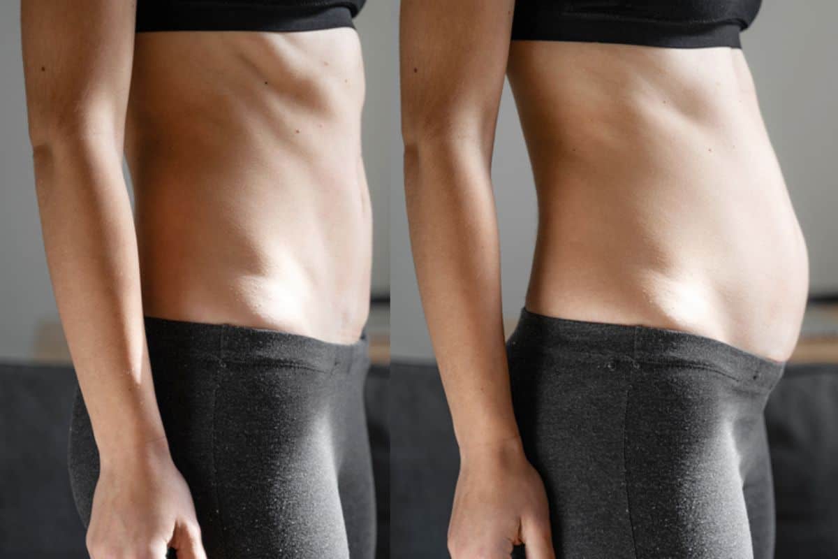 How long does diastasis recti take to improve Greater London (Hammersmith and Fulham)?