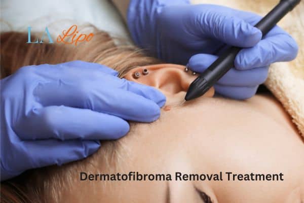 Dermatofibroma Removal Treatment Greater London (Hammersmith and Fulham)