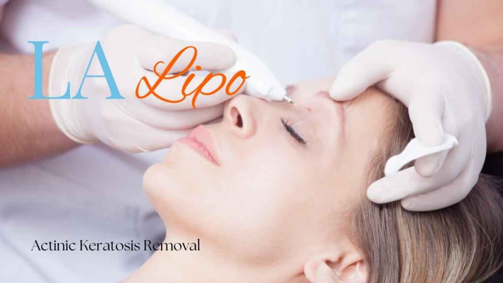 actinic keratosis removal Greater London (Hammersmith and Fulham)