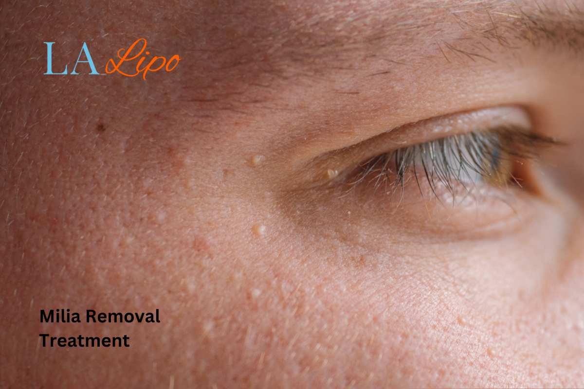 Cryopen Milia Removal: Is It the Easiest and Safest Option Greater London (Hammersmith and Fulham)?