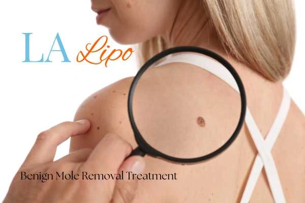 Why getting moles removed Greater London (Hammersmith and Fulham) can boost your confidence!