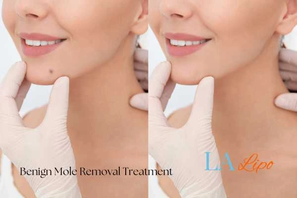 Woman's before and after results of being moles removal treatment Greater London (Hammersmith and Fulham)