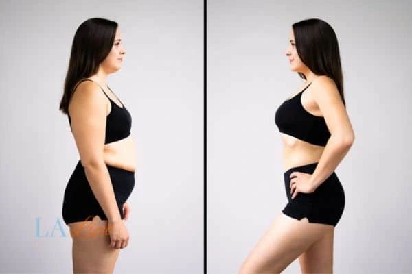 image of woman before and after results of LA-EMS Body Sculpting Greater London (Hammersmith and Fulham) to help treat Diastasis recti