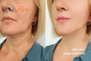 hi-fu for wrinkles Greater London (Hammersmith and Fulham) before and after results