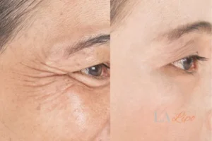 Before and after results of woman - HI-fu wrinkles reduction treatment Greater London (Hammersmith and Fulham)