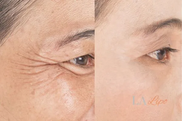 Before and after results of woman - HI-fu wrinkles reduction treatment Greater London (Hammersmith and Fulham)