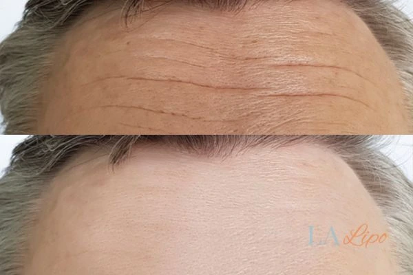 results of HIFU Greater London (Hammersmith and Fulham) on mans forehead to help reduce lines and wrinkles