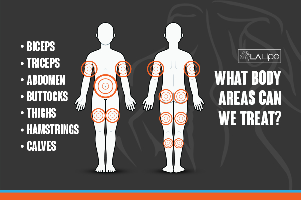 Graphic to show areas you can have LA-EMS Body Sculpting Greater London (Hammersmith and Fulham) treatment.