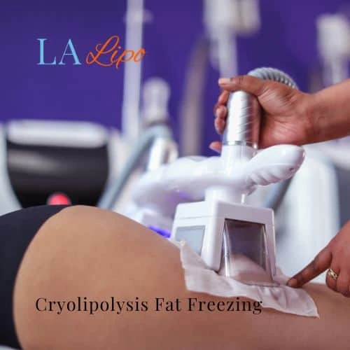 fat freezing - Cryolipolysis Greater London (Hammersmith and Fulham)