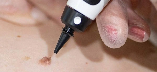 skin tag removal using cryopen Greater London (Hammersmith and Fulham)