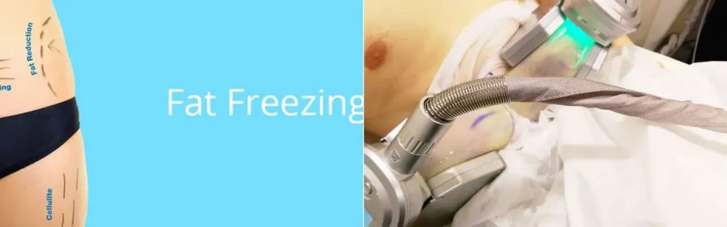 multi areas of a persons body having coolsculpting Greater London (Hammersmith and Fulham) treatment