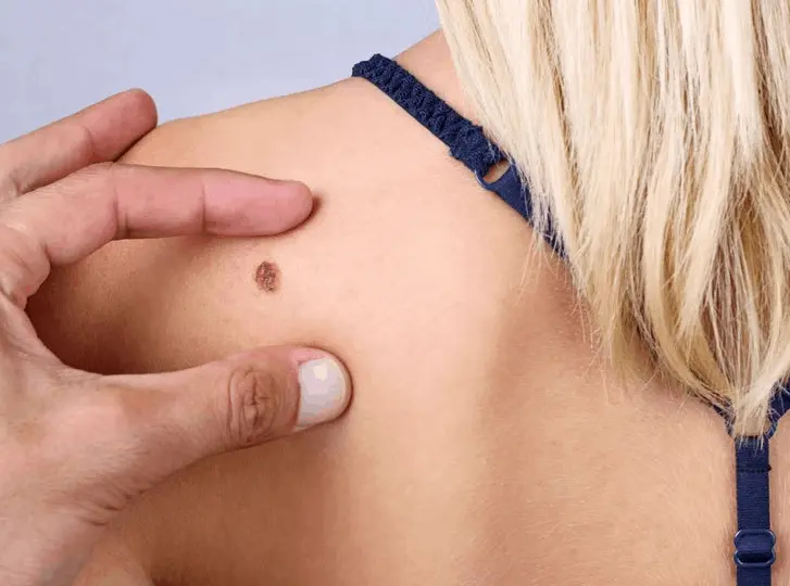 woman having mole removal Greater London (Hammersmith and Fulham) consultation before treatment.