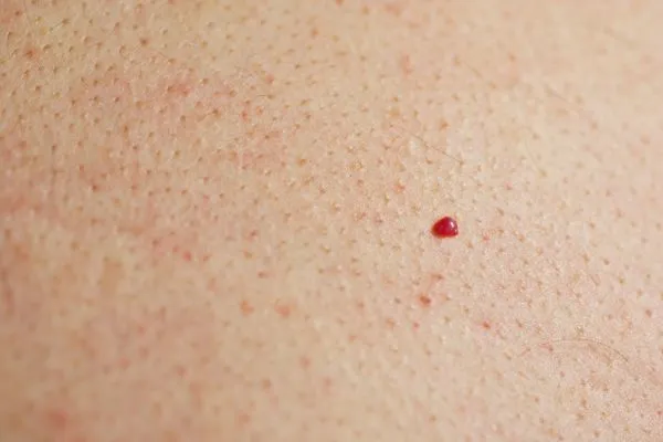 close up of a cherry angioma Greater London (Hammersmith and Fulham)