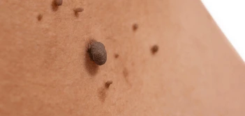 image of a skin tag Greater London (Hammersmith and Fulham)