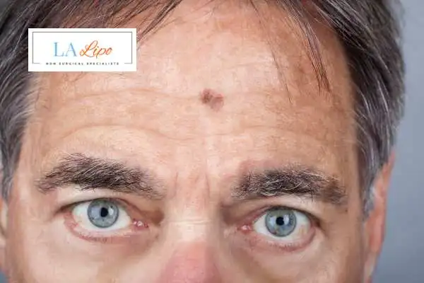 Solar Lentigo Removal Greater London (Hammersmith and Fulham) image of man with mark on his forehead