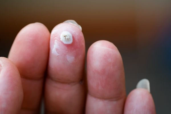 wart on person finger - cryotherapy to treat from LA LIPO Greater London (Hammersmith and Fulham)