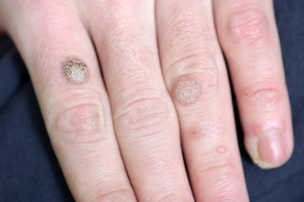 photo of warts on person hand - see wart removal Greater London (Hammersmith and Fulham) from LA LIPO