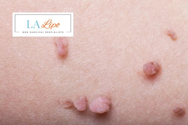 Does cryopen skin tag removal Greater London (Hammersmith and Fulham) hurt? Find out now call our team today!