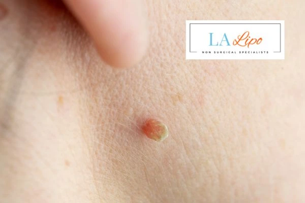 Book skin tag removal Greater London (Hammersmith and Fulham) today speak to our team now!
