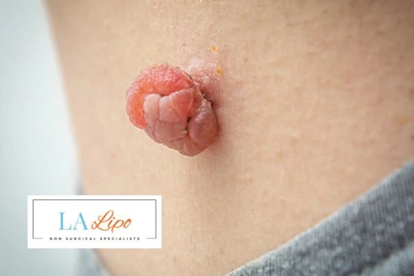 Interested in skin tag removal Greater London (Hammersmith and Fulham)? Concerned about the pain? Find out more today!
