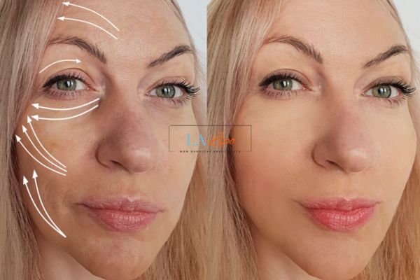 Morpheus 8 results Greater London (Hammersmith and Fulham) face lift.