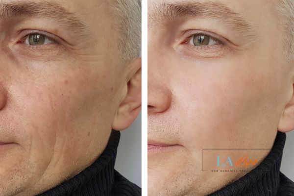 See the amazing results of Morpheus8 Treatment Greater London (Hammersmith and Fulham)!