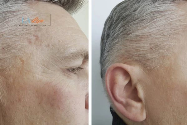 Mens Before & After Morpheus 8 Results Greater London (Hammersmith and Fulham)