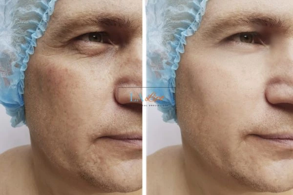 Before and after Morpheus 8 Results Greater London (Hammersmith and Fulham)