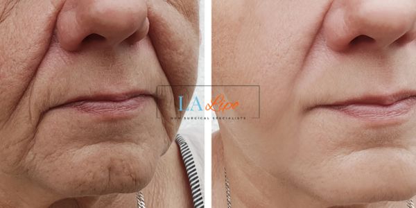 Older lady deeper wrinkle reduction - LA LIPO Morpheus 8 Results Greater London (Hammersmith and Fulham)