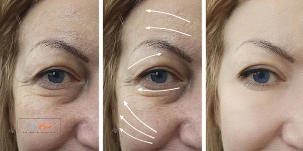 Amazing eye lift Morpheus 8 results Greater London (Hammersmith and Fulham)