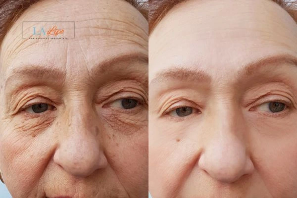 The powerful benefits of Morpheus8 Treatment Greater London (Hammersmith and Fulham) - Call Our team today!