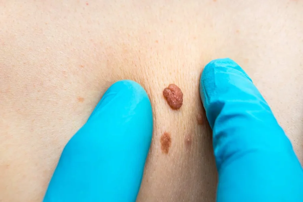 LA LIPO Cryopen Lesion Removal Prices Greater London (Hammersmith and Fulham)