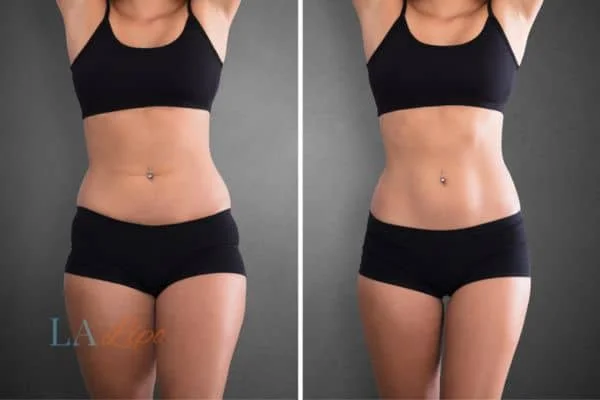 before and after results of non-surgical treatment to help a woman's body image and mental health Greater London (Hammersmith and Fulham)