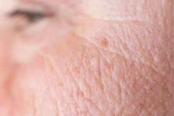 close up picture of a woman's face showing an age spot Greater London (Hammersmith and Fulham)