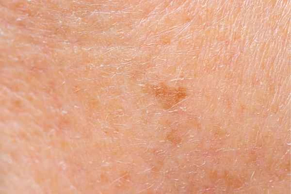 close up picture of age spots Greater London (Hammersmith and Fulham)