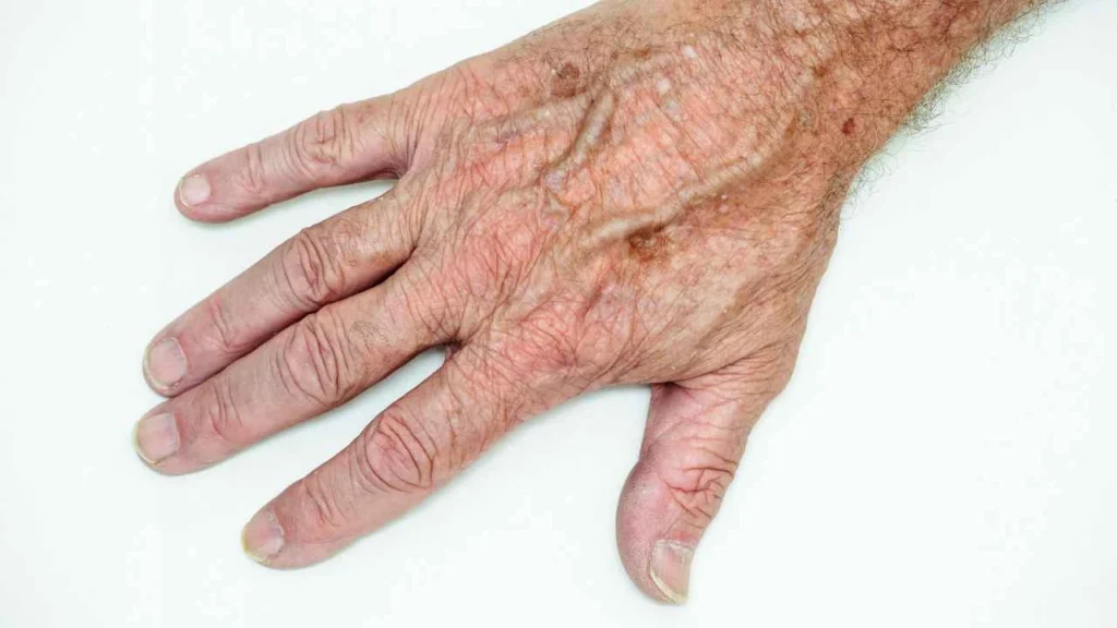 Male hand showing age spot Greater London (Hammersmith and Fulham)