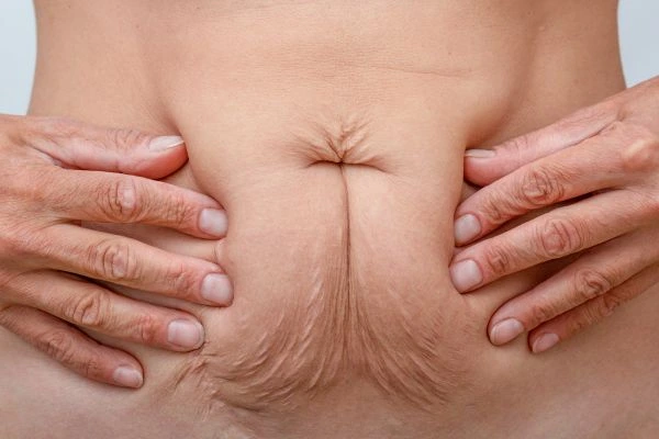 Image of a woman's stomach with loose skin - example of skin tightening Greater London (Hammersmith and Fulham) options