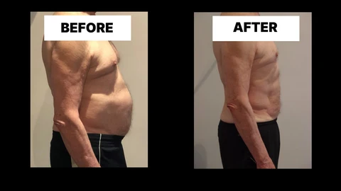 What Symptoms Can Diastasis Recti Cause in Men? Weak Core, Back Pain and Poor Posture Greater London (Hammersmith and Fulham)